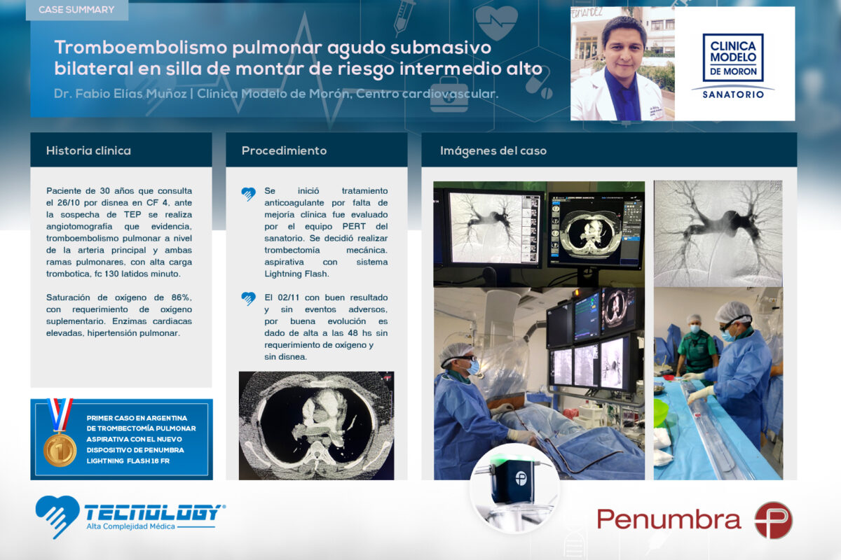 1 er caso en Argentina de trombectomía pulmonar aspirativa con el nuevo dispositivo de penumbra Lightning flash 16 Fr