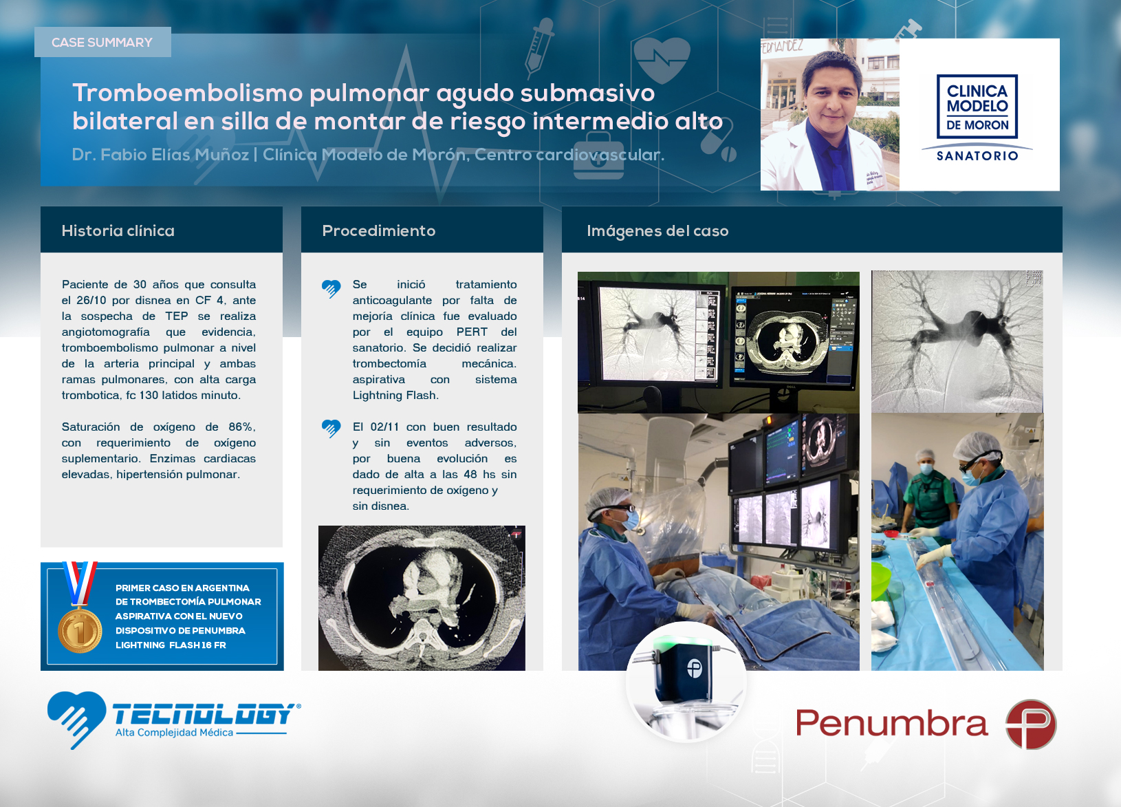 1 er caso en Argentina de trombectomía pulmonar aspirativa con el nuevo dispositivo de penumbra Lightning flash 16 Fr